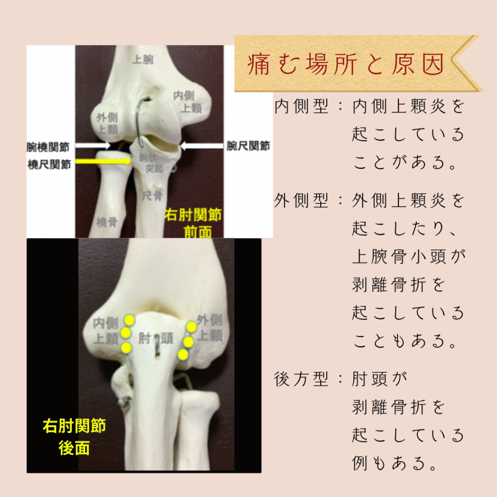肘の痛み、肘の障害、テニス肘、野球肘、ゴルフ肘、上腕骨外側上顆炎、上腕骨内側上顆炎、鎮痛剤、シップ、オステオパシー、沖縄南城市整体院、女性理学療法士、体の不調、姿勢、病気の改善、痛みの原因、根本的な原因、自然治癒力、恒常性