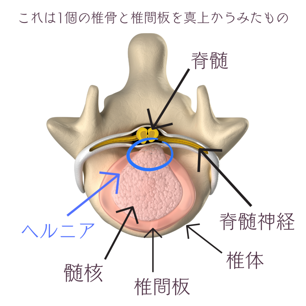 椎間板ヘルニア、痛みと痺れ、体の歪み、腰痛、お尻の痛み、あしの痛み、あしの痺れ、頚椎椎間板ヘルニア、腰椎椎間板ヘルニア、姿勢整体ケイポス、オステオパシー、女性理学療法士、女性整体師、沖縄県南城市、herniated disc、osteopathy、body distortion、physical illness、okinawa nanjo-city、female physical therapist