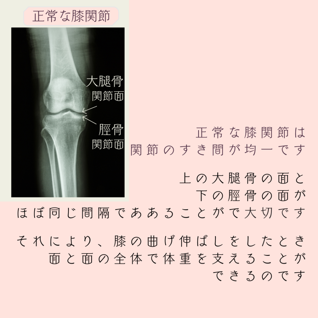 変形性膝関節症、OA、膝の変形、膝に水が溜まる、膝が腫れる、膝の痛み、膝が痛くて歩けない、人工膝関節、膝の手術、膝が痛くて階段昇降ができない、膝がキツイ、鎮痛剤、シップ、オステオパシー、沖縄南城市整体院、女性理学療法士、体の不調、姿勢、病気の改善、痛みの原因、根本的な原因、自然治癒力、恒常性