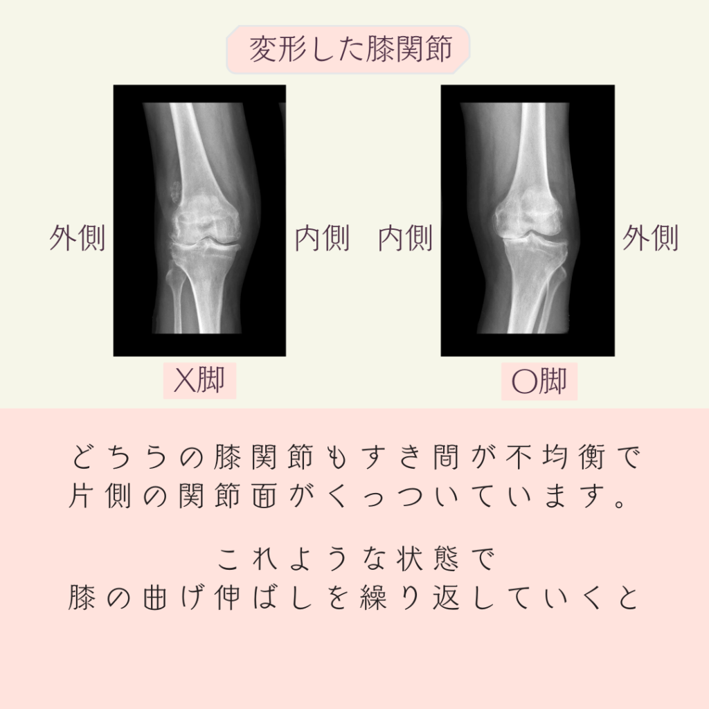 変形性膝関節症、OA、膝の変形、膝に水が溜まる、膝が腫れる、膝の痛み、膝が痛くて歩けない、人工膝関節、膝の手術、膝が痛くて階段昇降ができない、膝がキツイ、鎮痛剤、シップ、オステオパシー、沖縄南城市整体院、女性理学療法士、体の不調、姿勢、病気の改善、痛みの原因、根本的な原因、自然治癒力、恒常性