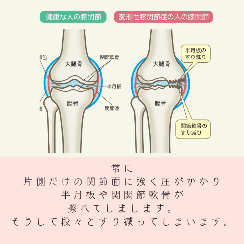 変形性膝関節症、OA、膝の変形、膝に水が溜まる、膝が腫れる、膝の痛み、膝が痛くて歩けない、人工膝関節、膝の手術、膝が痛くて階段昇降ができない、膝がキツイ、鎮痛剤、シップ、オステオパシー、沖縄南城市整体院、女性理学療法士、体の不調、姿勢、病気の改善、痛みの原因、根本的な原因、自然治癒力、恒常性